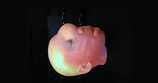 Impressão 3D auxilia na correção de deformação craniana com biomodelo 1